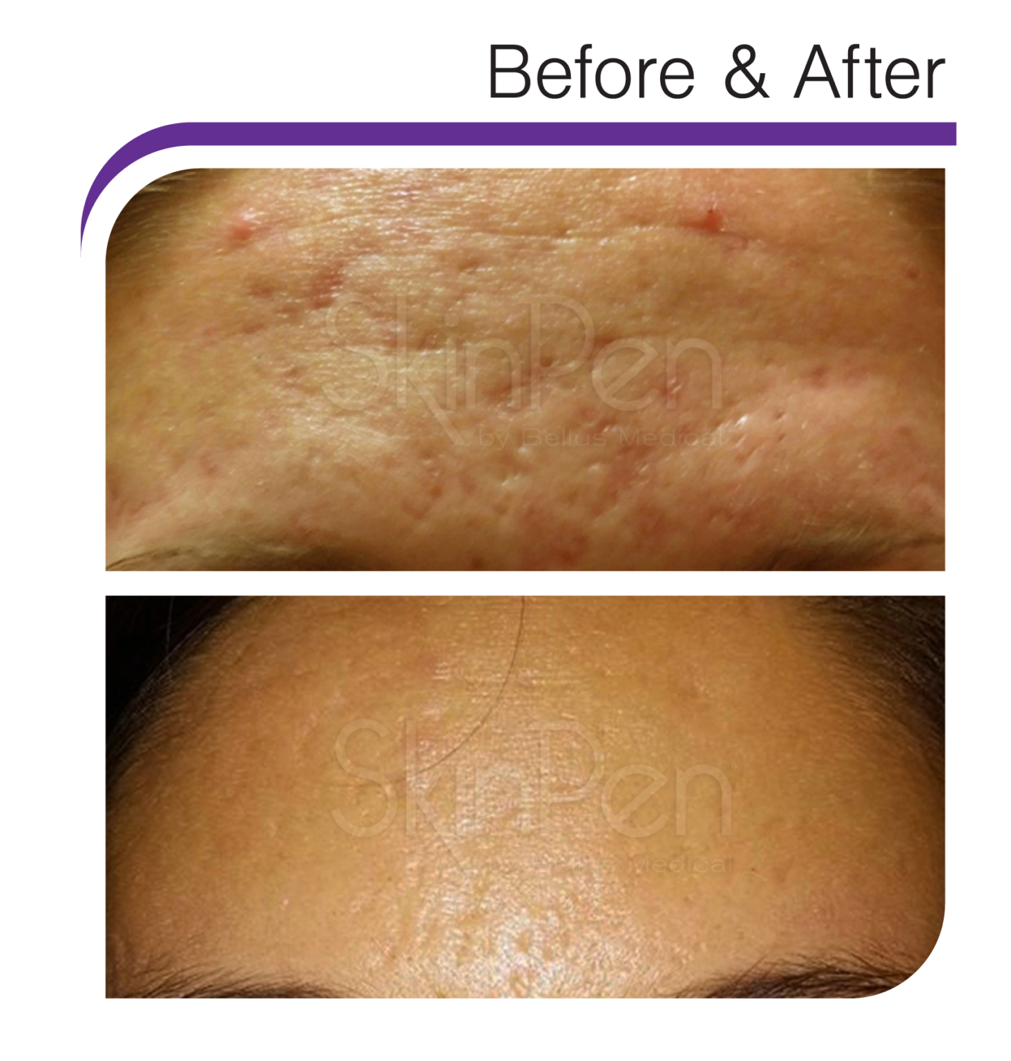 best-treatments-to-eliminate-acne-scarring-sante-med-spa