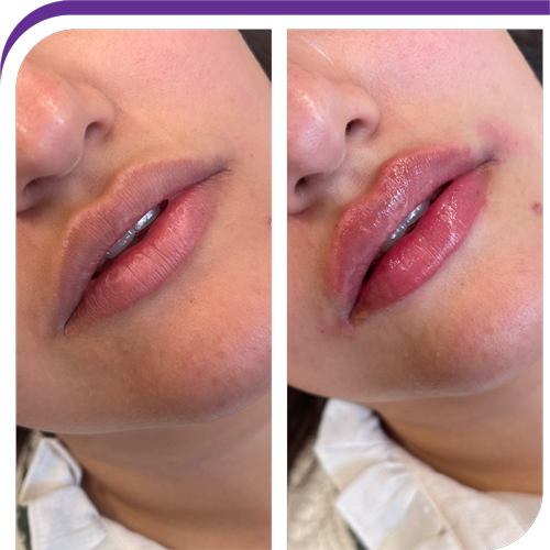 Dermal Fillers Sante Med Spa