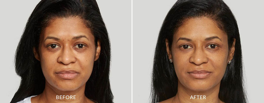 image of an Sculptra before and after