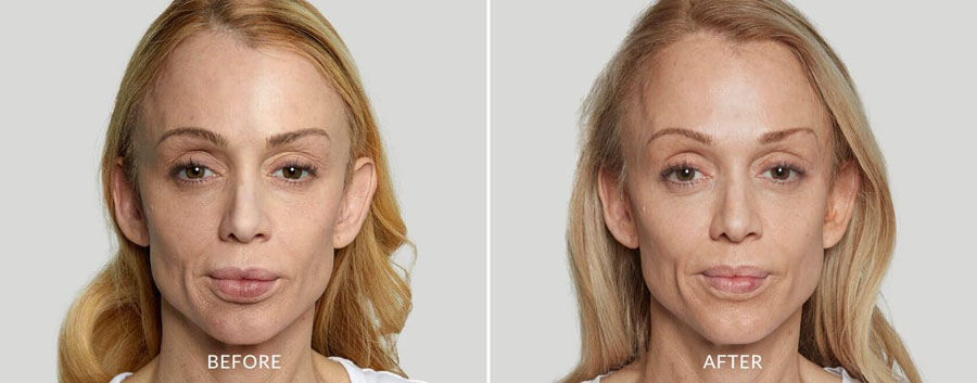 image of an Sculptra before and after