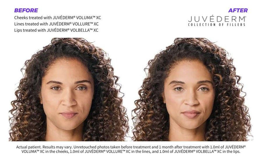 juvederm-fillers-before-and-after Santé 6