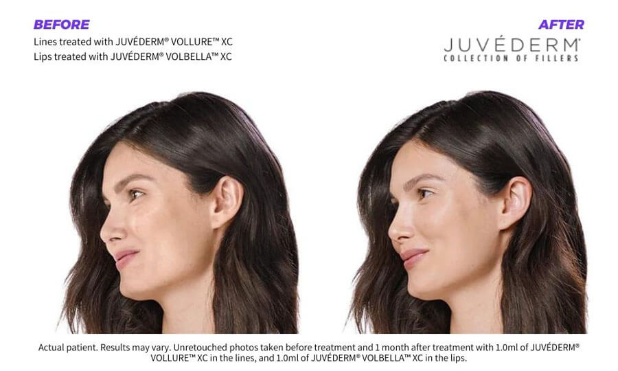 juvederm-fillers-before-and-after-Santé 8