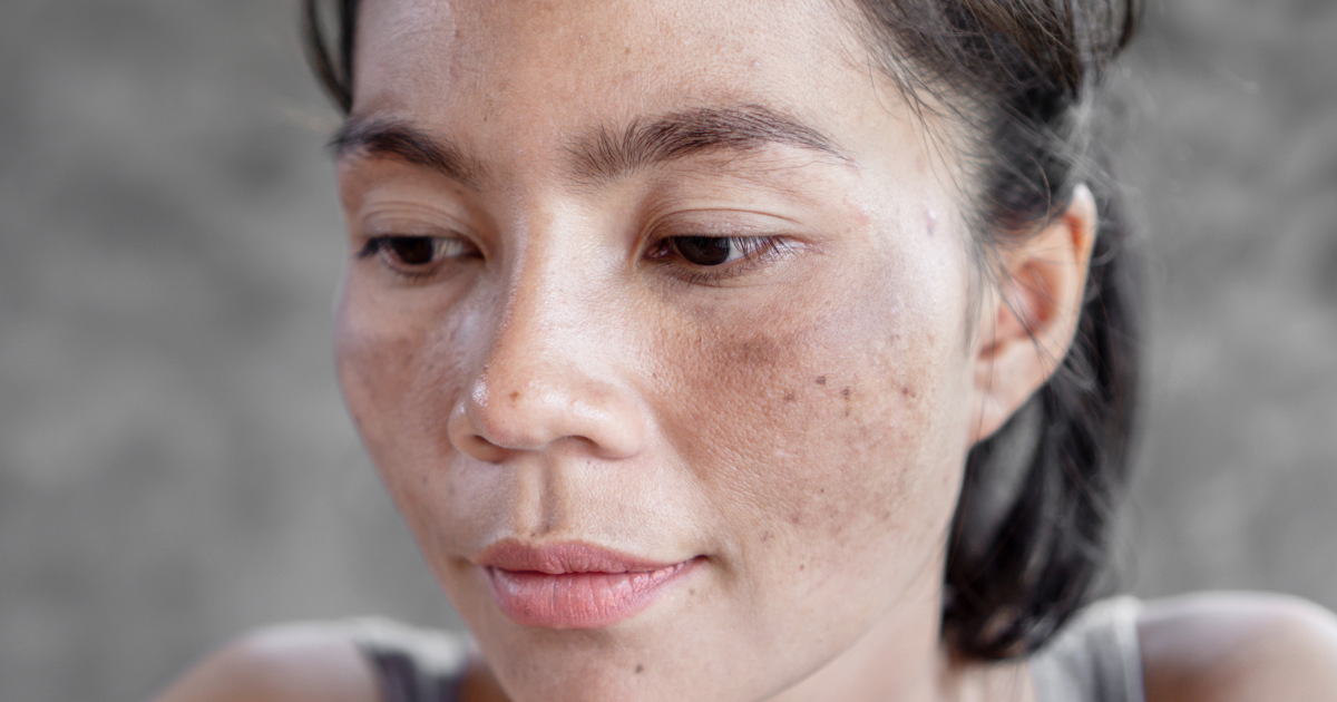 image of a woman with melasma